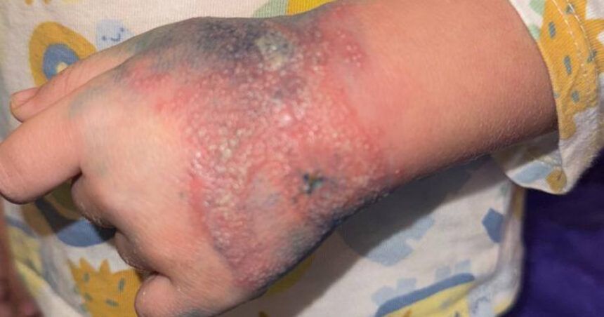 Anchetă la Spitalul Râmnicu Vâlcea, după imaginile unui copil cu mâna tumefiată din cauza unei branule neschimbate timp de 4 zile 1 ancheta la spitalul ramnicu valcea dupa imaginile cu un copil cu mana tumefiata din cauza unei branule neschimbate de 4 zile 679b72a06e662