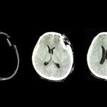 sa fie o casca de stimulare a creierului raspunsul la depresie 678e0d136edc8