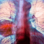 diagnosticele de cancer pulmonar sunt in crestere in randul persoanelor care nu fumeaza niciodata 67a1d164e85a3