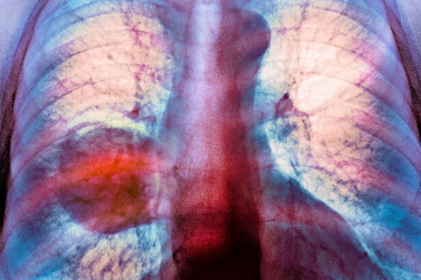 diagnosticele de cancer pulmonar sunt in crestere in randul persoanelor care nu fumeaza niciodata 67a1d164e85a3