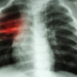 crestere alarmanta a cazurilor de tuberculoza la copii in europa si asia centrala oms cere masuri imediate 67e12b115312e