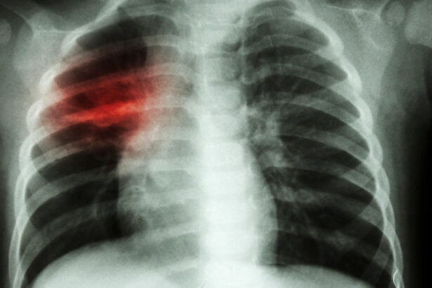 crestere alarmanta a cazurilor de tuberculoza la copii in europa si asia centrala oms cere masuri imediate 67e12b115312e