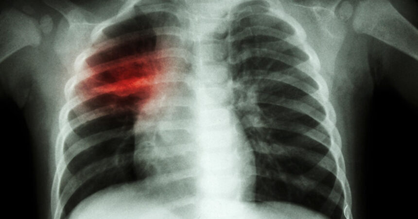 crestere alarmanta a cazurilor de tuberculoza la copii in europa si asia centrala oms cere masuri imediate 67e12b115312e