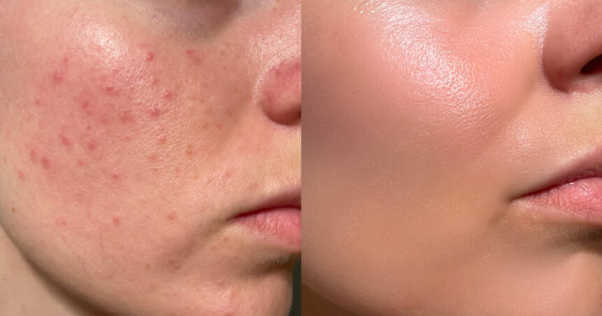 primul vaccin impotriva acneei moderate si severe in faza de testare clinica in cat timp ar putea ajunge la pacienti 680e2f4dc5707