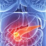 un nou test ar putea depista cancerul pancreatic in stadiile initiale 6851c4efa4613