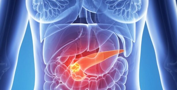 un nou test ar putea depista cancerul pancreatic in stadiile initiale 6851c4efa4613
