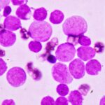 cazurile de cancer in randul celor de sub 50 de ani problema tot mai ingrijoratoare 687751175d0da