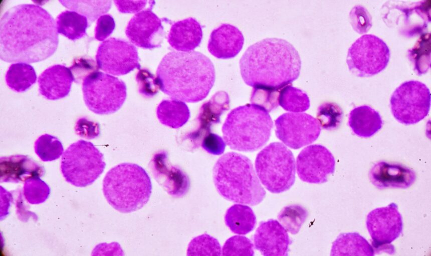 cazurile de cancer in randul celor de sub 50 de ani problema tot mai ingrijoratoare 687751175d0da