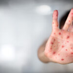 moartea unui copil bolnav de rujeola a starnit un val de conspiratii antivacciniste in marea britanie 687de35aed653