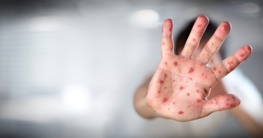 moartea unui copil bolnav de rujeola a starnit un val de conspiratii antivacciniste in marea britanie 687de35aed653