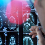 un medicament pentru tratarea bolii alzheimer in stadii timpurii este aproape de autorizare in ue ce este donanemab 68861a329a6f5
