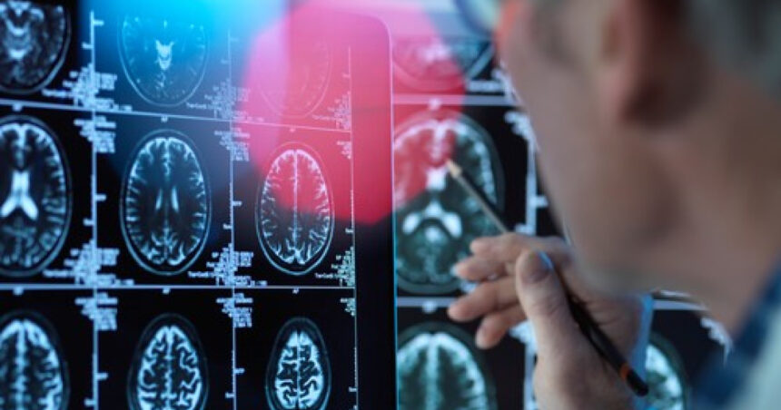 un medicament pentru tratarea bolii alzheimer in stadii timpurii este aproape de autorizare in ue ce este donanemab 68861a329a6f5