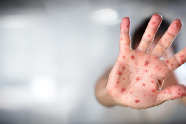 lupta oamenilor lui trump cu stiinta vaccinul contra rujeolei nu mai este recomandat contrar avizelor medicilor 68cd1d0d07561