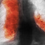 numarul deceselor cauzate de cancer ar urma sa creasca semnificativ pana in 2050 cele mai frecvente si cele mai mortale studiu 68d4ff28b004a