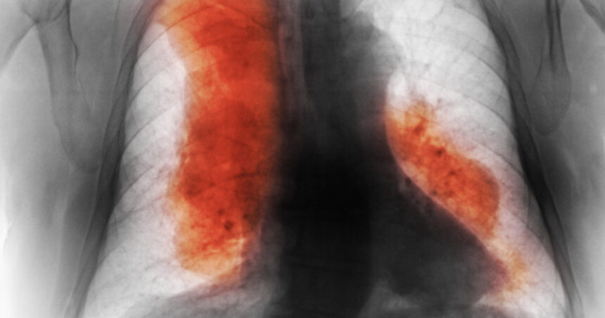 numarul deceselor cauzate de cancer ar urma sa creasca semnificativ pana in 2050 cele mai frecvente si cele mai mortale studiu 68d4ff28b004a