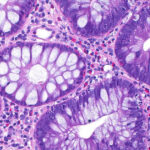 cum a ajuns cancerul de colon sa afecteze tot mai multi tineri si care este cauza principala indicata de studii 68e340166c4a0
