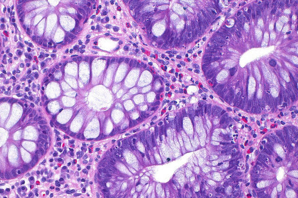cum a ajuns cancerul de colon sa afecteze tot mai multi tineri si care este cauza principala indicata de studii 68e340166c4a0