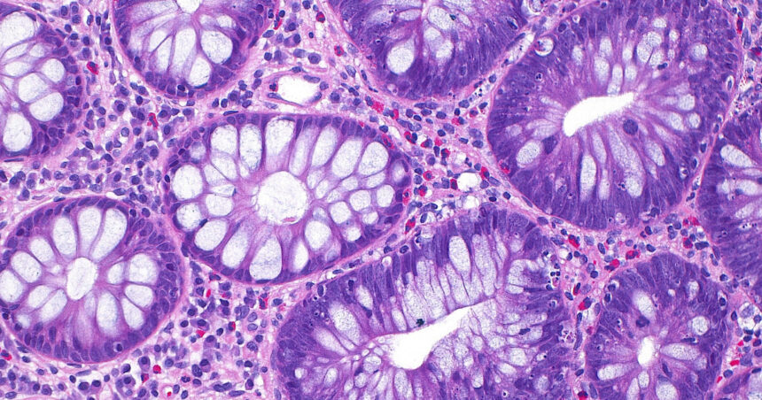 cum a ajuns cancerul de colon sa afecteze tot mai multi tineri si care este cauza principala indicata de studii 68e340166c4a0