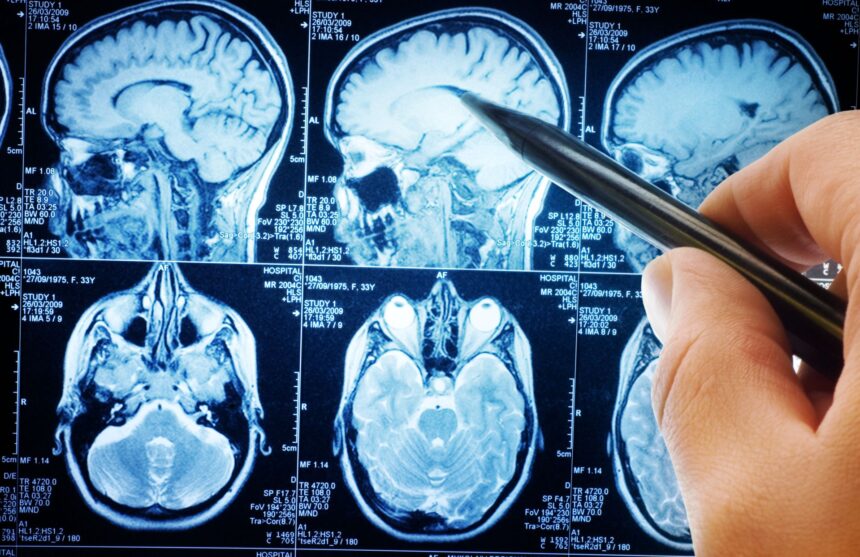 oamenii de stiinta descopera un circuit cerebral care poate opri durerea cronica 68ee6159756d4