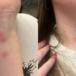 video o tanara a ajuns la spital dupa ce a fost muscata de plosnite intr un tren cfr familia a facut plangere 6922d24edcae0