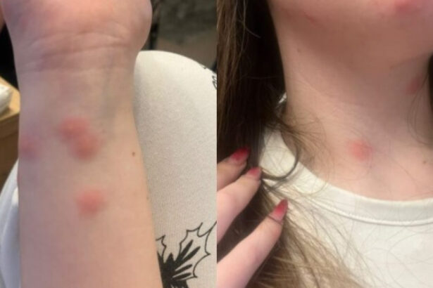 video o tanara a ajuns la spital dupa ce a fost muscata de plosnite intr un tren cfr familia a facut plangere 6922d24edcae0