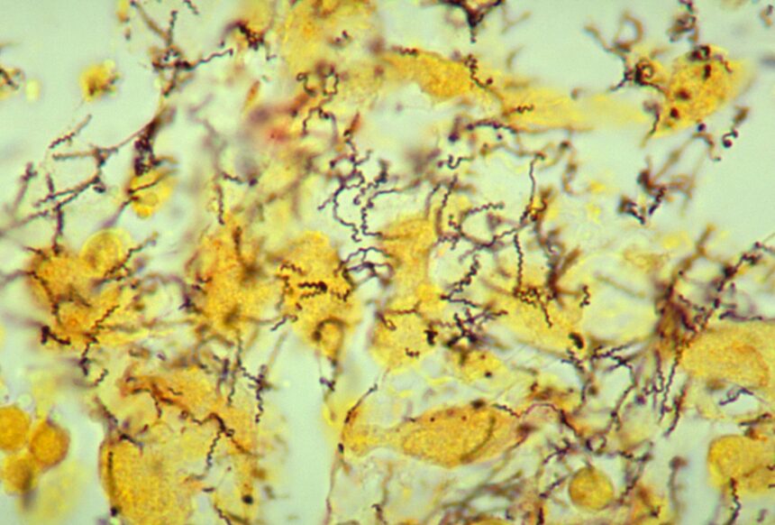 cea mai veche dovada pentru originea sifilisului descoperita pe un schelet vechi de 5 500 de ani 697641527fb7b