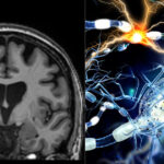 studiu covid 19 poate lasa modificari detectabile in creier chiar si dupa recuperare completa 69575256d91cd