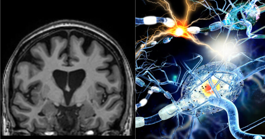 studiu covid 19 poate lasa modificari detectabile in creier chiar si dupa recuperare completa 69575256d91cd