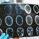 asociatiile de pacienti cer interventia ministerului sanatatii si cnas dupa scaderea cu 47 a investigatiilor de monitorizare 69cf91a2c08cc